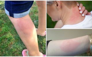 Alerģiju ārstēšana ar moskītu kodumiem pieaugušajiem un bērniem